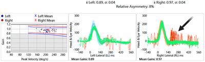 Case report: Acute audiovestibular presentation following hemi-pontine infarction